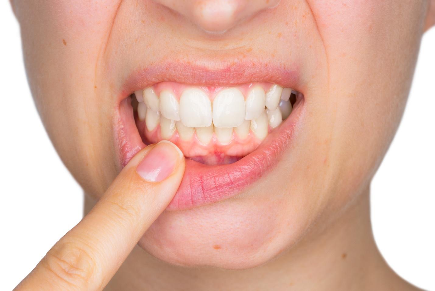 女性牙周病恐增加癌症風險？！